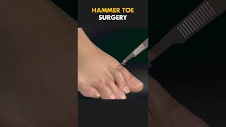 Hammer Toe Repair Surgery 3D Animation hammertoe medical medical 3danimation [upl. by Richart]