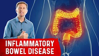 The Most Common Nutrient Deficiency in IBD Inflammatory Bowel Disease [upl. by Aivart677]