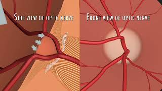 What are the nerve fibers as it relates to glaucoma [upl. by Sutsuj343]