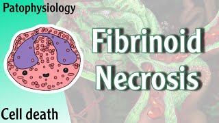 Pathophysiology  Fibrinoid Necrosis Hani Laith شرح [upl. by Asilrak]