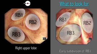 Mastering Bronchoscopy for Thoracic Surgery Chapter 2 [upl. by Phox258]