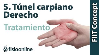 Tratamiento del síndrome de túnel carpiano derecho [upl. by Fiden]