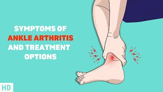 Dont Ignore Your Ankle Pain Understanding Ankle Arthritis [upl. by Lectra]