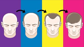 Top 5 Hair Loss Solutions That Actually Work [upl. by Adrahc]