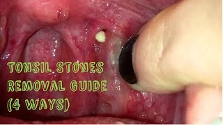 How to Remove Tonsil Stones Tonsillitis at Home [upl. by Haida]