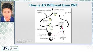 Neuroimmune Underpinnings of Prurigo Nodularis [upl. by Bensen]