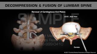 Decompression amp Fusion of Lumbar Spine [upl. by Adnorahc]