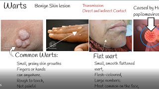 Warts causes and treatment Wart Types [upl. by Karry]