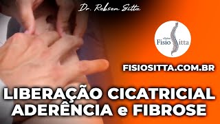 MASSAGEM de LIBERAÇÃO CICATRICIAL PREVENÇÃO ADERÊNCIA FIBROSE Clínica Fisioterapia Dr Robson Sitta [upl. by Attenwahs]