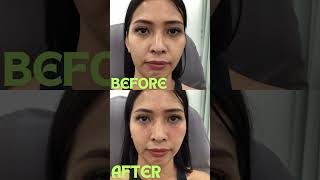 Liquid face lift aesthetics botox cosmeticsurgery medconsultclinic skincare [upl. by Eerak]