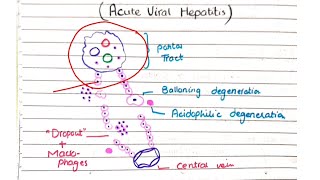 Acute and Chronic Viral Hepatitis  Pathology [upl. by Leyla270]