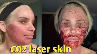 7Day Journey My CO2 Laser Skin Resurfacing Experience – Before and after chris link [upl. by Swan432]