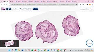 Basel cell carcinoma and pinkus variant [upl. by Netsrik]