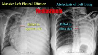 pleural effusion vs atelectasis [upl. by Kwabena]