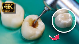 IMPRESIONANTE restauración dental en 4K [upl. by Niad826]