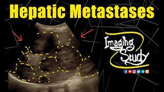 Hepatic Metastases  Ultrasound  Case 311 [upl. by Eusadnilem]