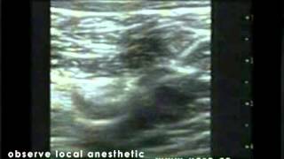 Subgluteal Sciatic Nerve Block  Out of Plane Approach [upl. by Missie212]