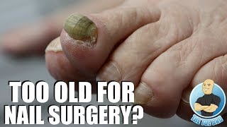 80 YEAR OLD WOMAN WANTS RAMS HORN TOENAIL GONE FOR GOOD [upl. by Berri]