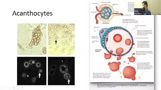 APPROACH TO NEPHRITIC AND NEPHROTIC SYNDROMES  DR JAYAPRAKASH THANGAVEL NEPHROLOGY [upl. by Auqeenwahs262]