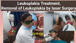 Leukoplakia TreatmentRemoval of Leukoplakia by laser Surgery [upl. by Divadnahtanoj]