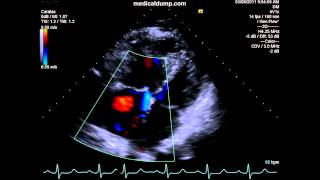 Severe Pulmonary HTN  Pulmonary Regurgitation  TTE [upl. by Aloivaf]