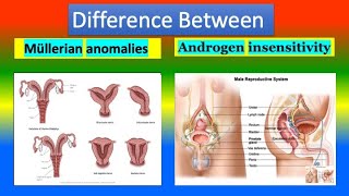 Difference Between Mullerian Anomalies Agenesis and Androgen Insensitivity [upl. by Kapor489]