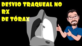 DESVIO TRAQUEAL NA RADIOGRAFIA DE TÓRAX [upl. by Noemi229]