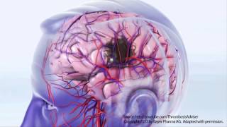 AFIB and StrokeMicrolife [upl. by Nakah]