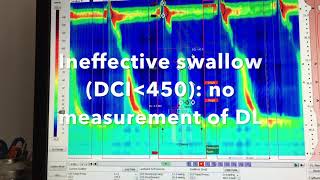 Analysis of Esophageal High Resolution Manometry ESNM Teaching Video [upl. by Collie]