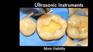 Finishing of Cavity Margins for Direct Posterior Resin Composite Restorations [upl. by Louie340]