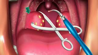 Animation Surgery of Tonsillectomy amp Adenoids [upl. by Connett]