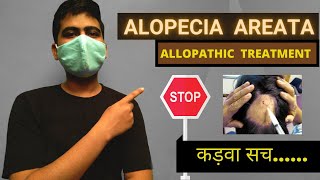 Alopecia Areata Allopathic Treatment Reality in Hindi  Steroids Side Effects in Alopecia Treatment [upl. by Lewin]