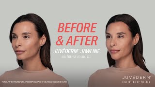 A Smooth Contour In The Jawline With JUVÉDERM® Filler  Lara’s Before amp After [upl. by Ecahc214]