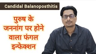 Candidal Balanoposthitis  पुरुष के अंग पर होने वाला फंगल इन्फेक्शन  Fungal infection candida [upl. by Gessner]