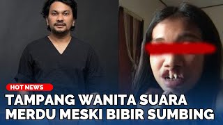 Tampang Wanita Suara Merdu Meski Bibir Sumbing Kini Dibiayai Operasi Oleh Dokter Tompi [upl. by Olegnaed]