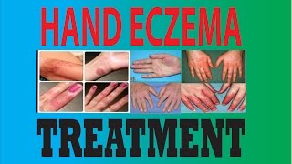 DyshidrosisDyshidrotic eczemaHand eczemaPompholyx treatment [upl. by Llerrit]