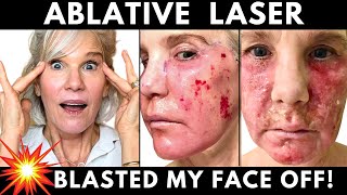 Skin LASER RESURFACING My One Year Recovery Journey Week by Week [upl. by Bass]