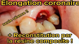 Élongation coronaire et reconstitution en une seule séance ‼️ [upl. by Chari]