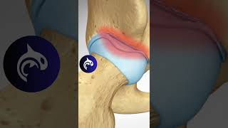 See what a Labral Tear of the Hip looks like in 3D animation hiparthritis arthritis anatomy [upl. by Aillil]