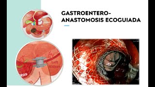 Gastroenteroanastomosis Ecoguiada con Stent LAMS [upl. by Andres]