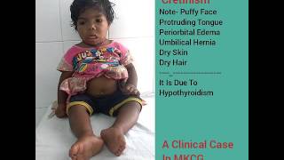 Congenital cretinism A clinical case in MKCG by asim Swain [upl. by Magbie]