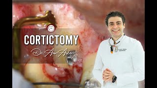 Corticotomy of impacted canine in orthodontics [upl. by Lishe]