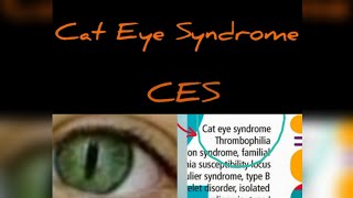 Cat Eye Syndrome CES chromosome 22 aberration In English [upl. by Olia280]