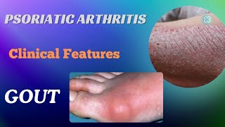 Psoriatic Arthritis amp Gout  Clinical Features Treatment [upl. by Etnoid]