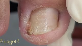 TRANSFORMAÇÃO satisfying ingrowntoenail [upl. by Christin]