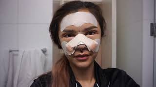 MY PLASTIC SURGERY STORY PART 2 RECOVERY BAHASA INDONESIA ENG SUB SANLY LIU X BEAUTIQUE KOREA [upl. by Anidam225]