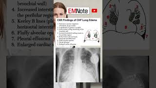 Chest X Ray of Lung Edema medical doctor nursing [upl. by Battiste]