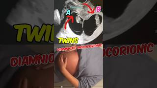 Double joy Twins ultrasound  Diamniotic Monochorionic  Girls pregnancy babyshorts [upl. by Adnawal915]