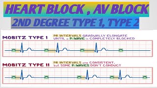 HEART BLOCK AV BLOCK SECOND DEGREE HEART BLOCKMOBITZ 1 2  أنسداد الدفيرة الكهربائية أحصار القلب [upl. by Idak]