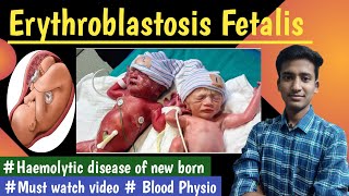 Erythroblastosis FetalisRh incompatibility  Blood Physio LecturesMBBS hindi Ashish [upl. by Berte]